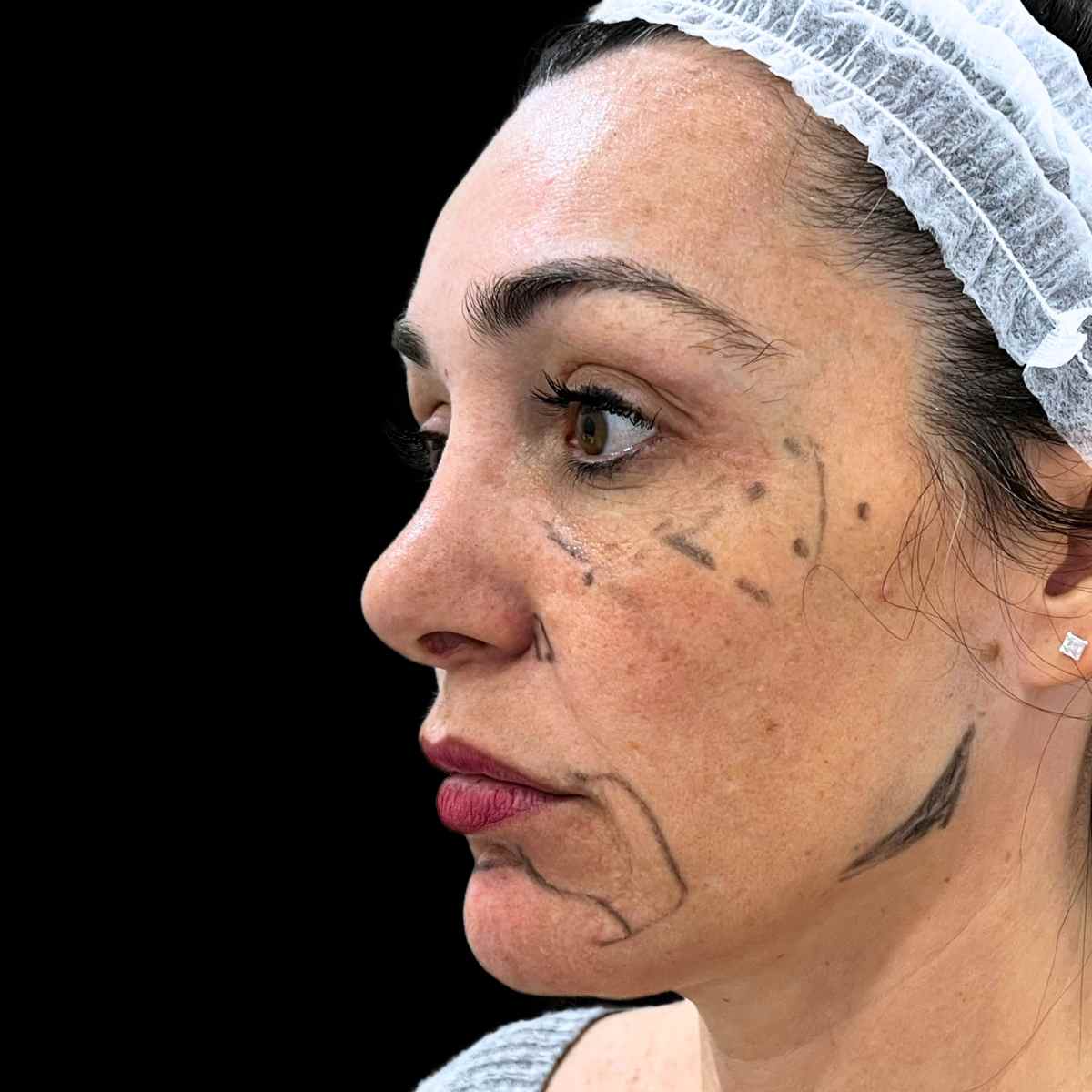 Imagen tratamiento de armonización facial con evaluación del rostro en Clinica Roma,la mejor clinica de medicina estetica Malaga