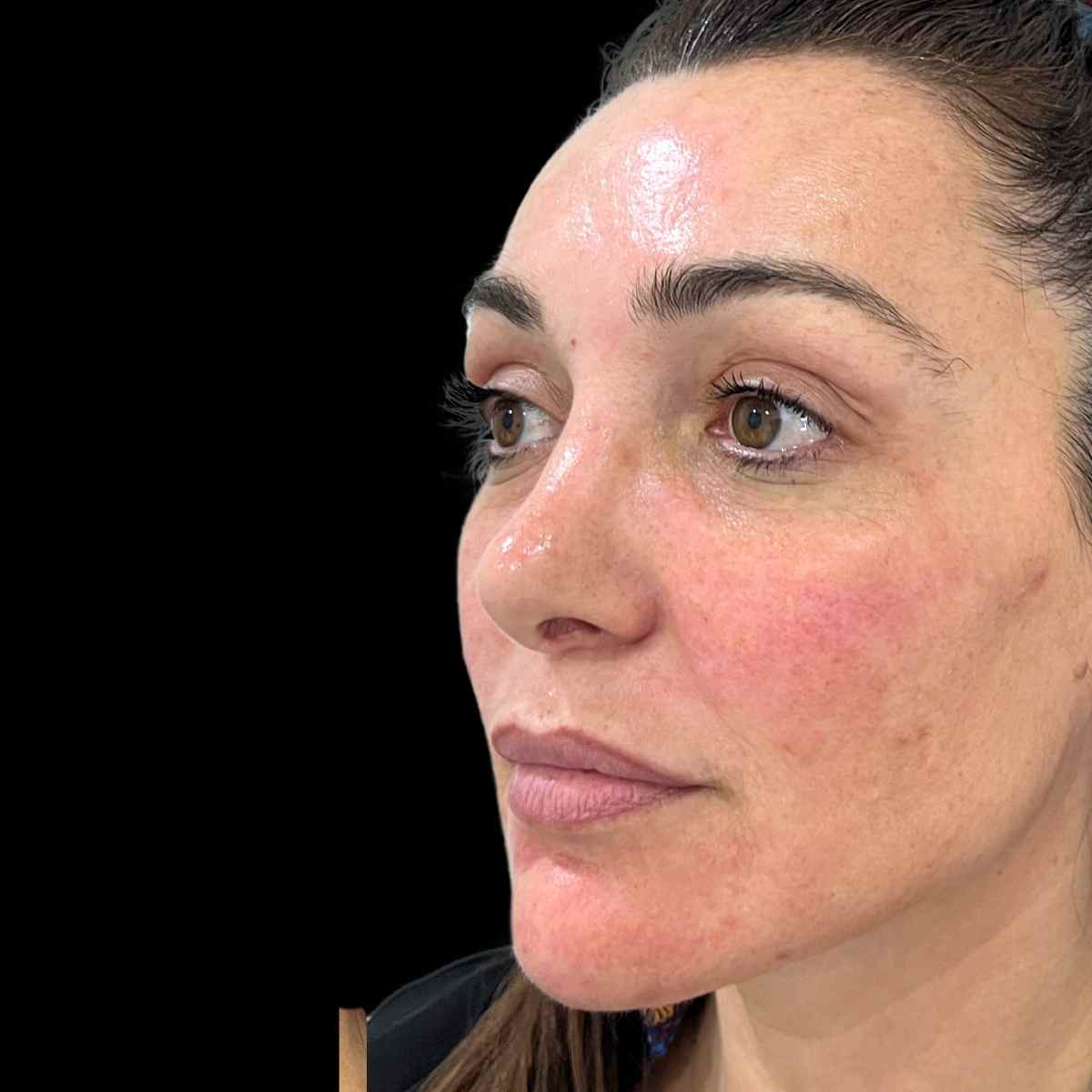 procedimiento de armonización facial en Clinica Roma, la mejor clinica estetica Málaga