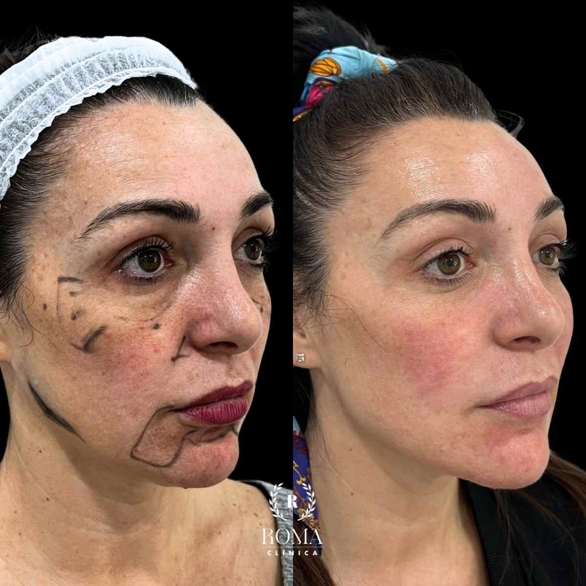 Armonización Facial en la mejor clinica estetica malaga – clinica Roma Imagen armonización facial antes y después con medicina estetica malaga en la mejor clinica estetica