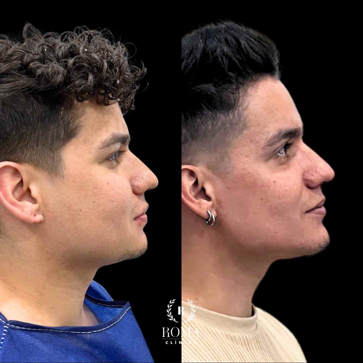 Resultados de armonizacion facial en hombre, Clinica Roma, profesionales en medicina estetica malaga Imagen perfil facial antes y después de tratamiento de armonización facial en Clinica Roma, la mejor clinica estetica Malaga