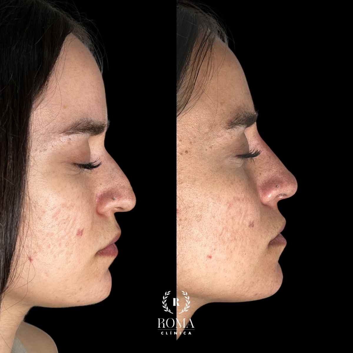 Resultados de Medicina Estética Facial en la mejor clinica de medicina estetica malaga Imagen perfil facial de una mujer antes y después de un tratamiento de medicina estética facial en Clinica Roma, Malaga, los mejores en medicina estetica