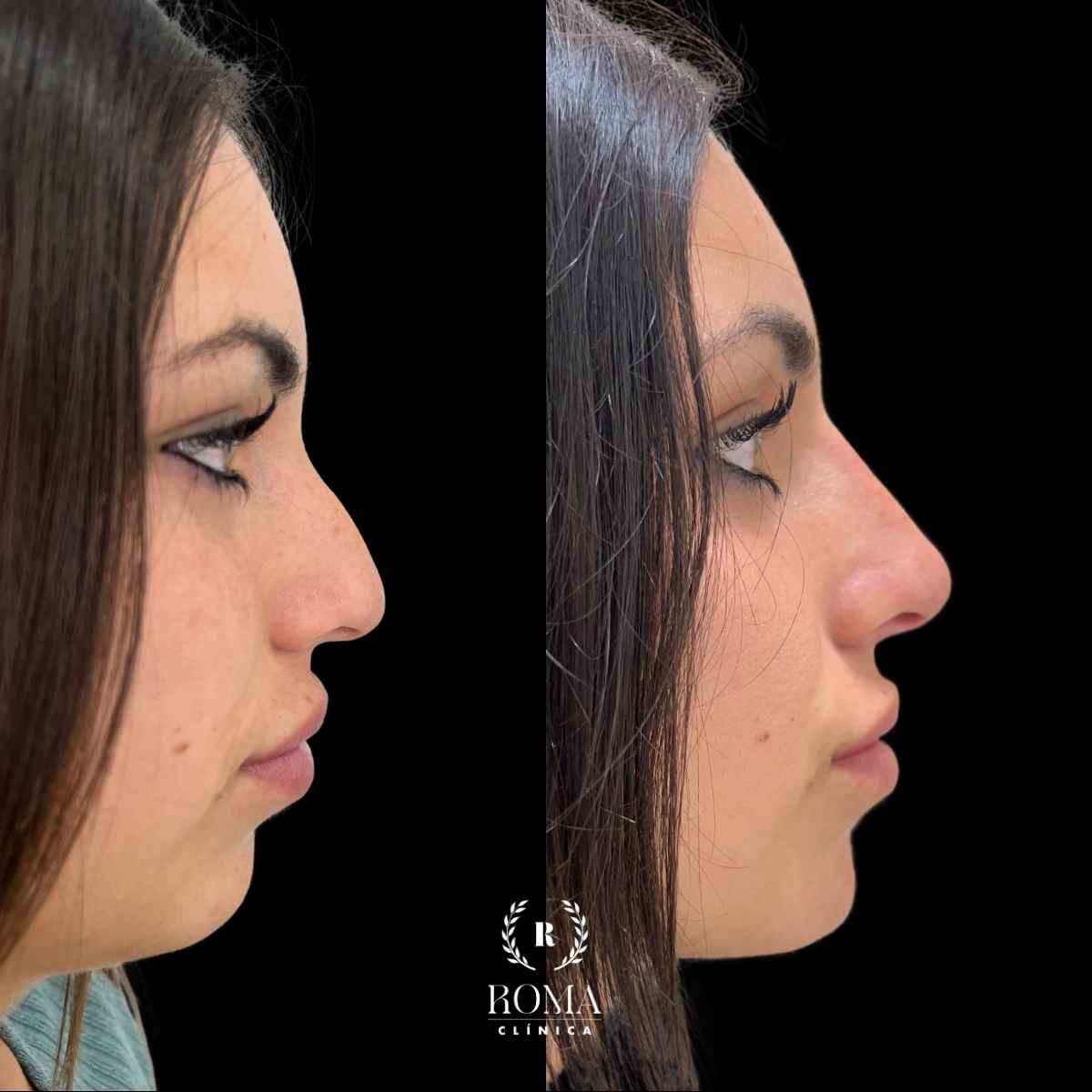 Resultados de Medicina Estética Facial en la mejor clinica estetica malaga: Clinica Roma Imagen perfil facial antes y después de un tratamiento de medicina estetica facial en una mujer, en Clinica Roma, la mejor clinica estetica Malaga