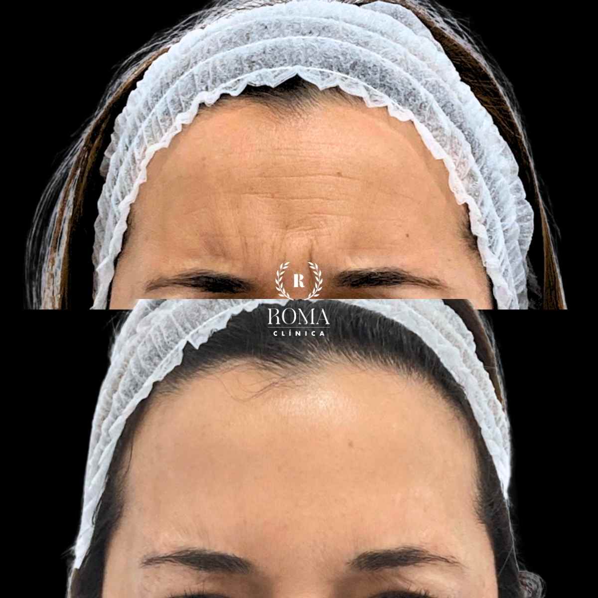 la mejor clínica estética de malaga en reducción de lineas de expresión imagen antes y después paciente procedimiento neuromoduladores