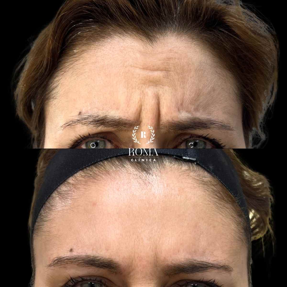 la mejor clínica de medicina estetica en malaga Imagen antes y después líneas de expresión procedimiento neuromoduladores