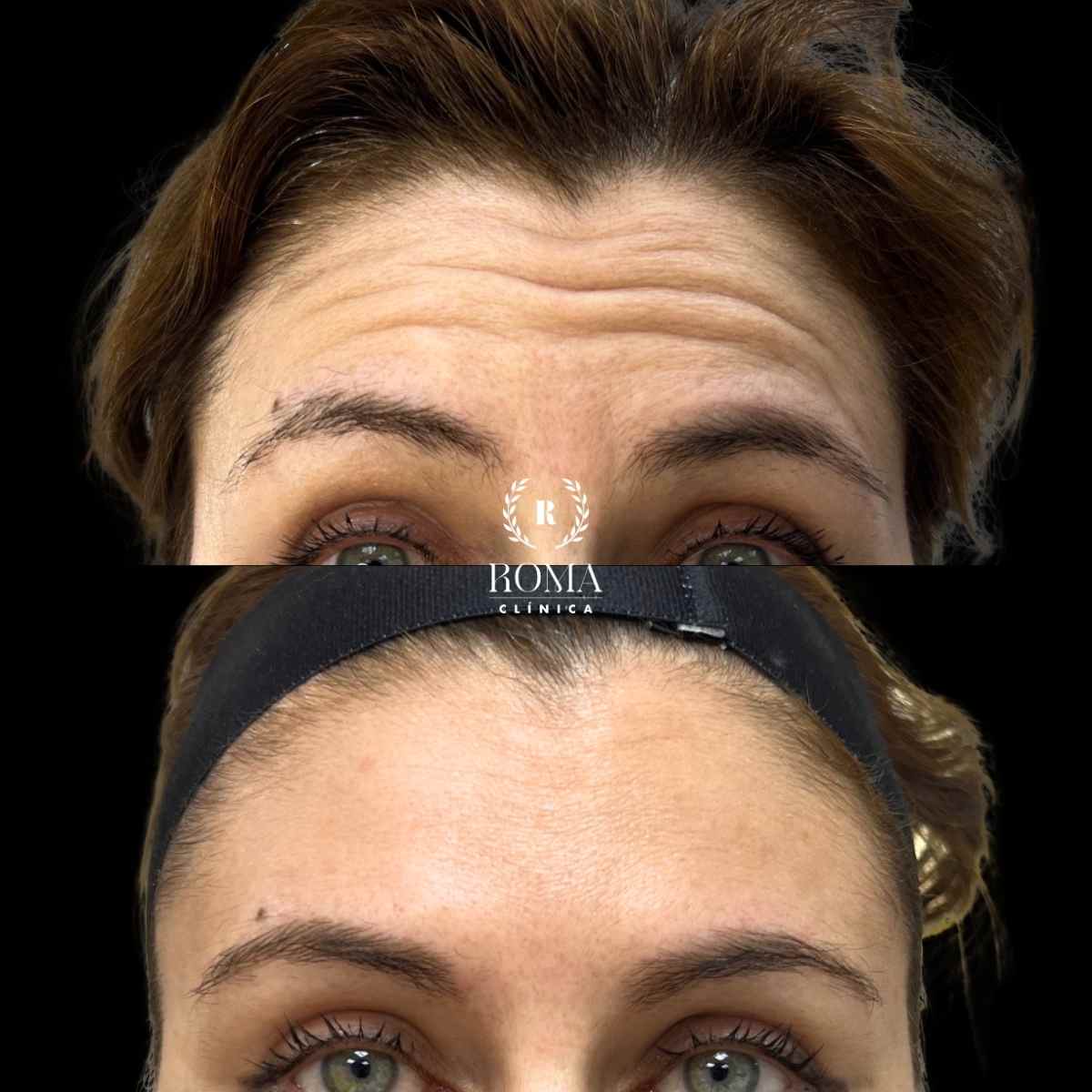 la mejor clinica estetica de málaga en reducción de lineas de expresión la mejor clinica estetica de málaga en reducción de lineas de expresión