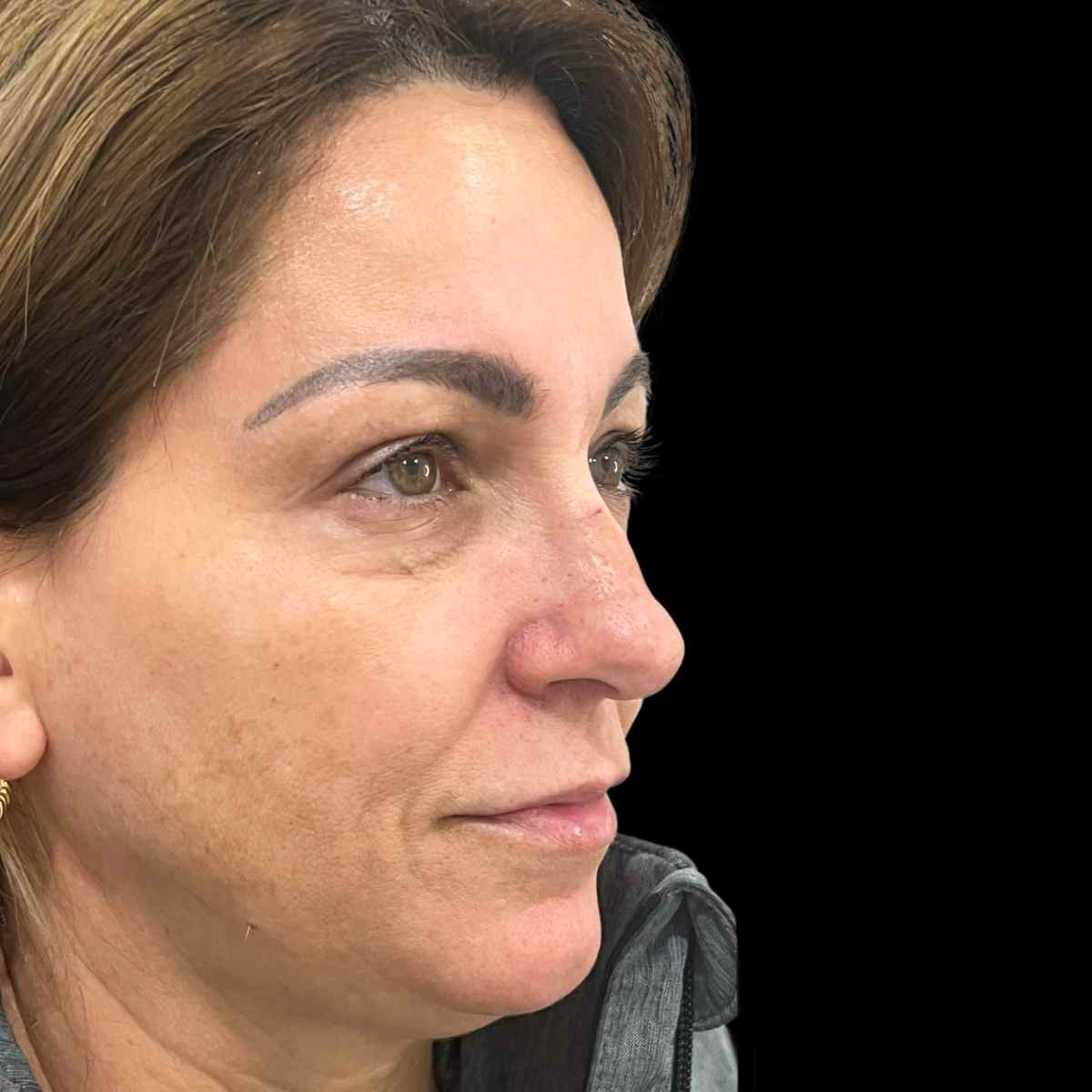 Imagen procedimiento antes relleno de ojeras