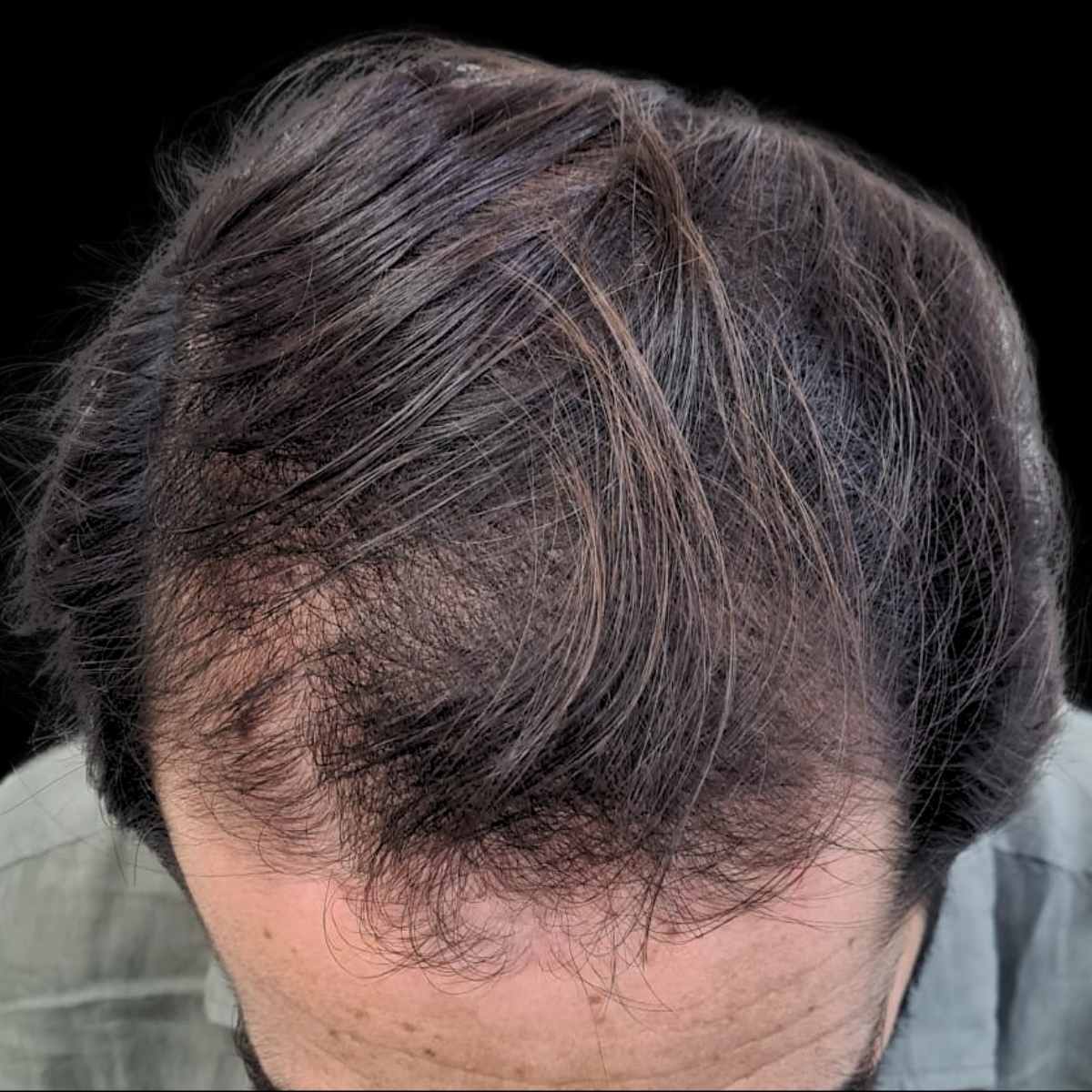 después de tratamiento capilar en la mejor clinica estetica malaga, Clinica Roma