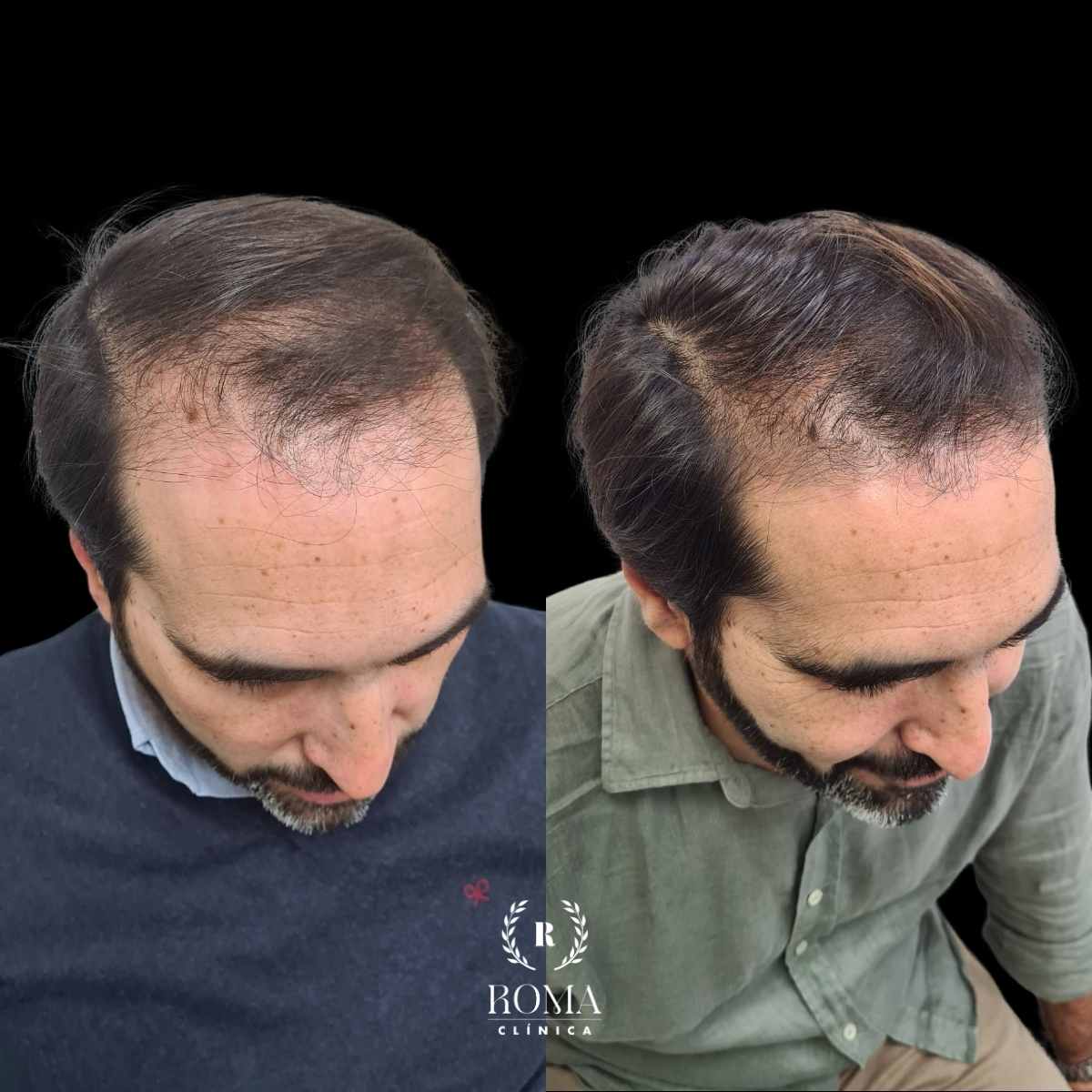 Clinica Roma, la mejor clinica estetica malaga en tratamiento capilar resultado de tratamiento capilar con medicina estetica malaga