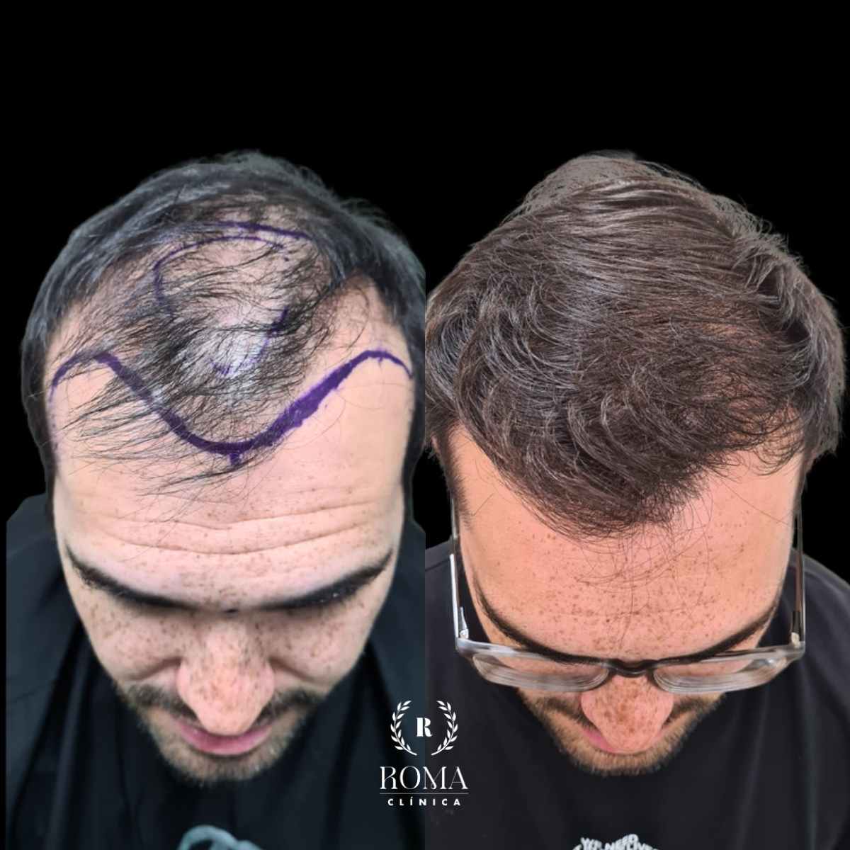La mejor clínica estética para tu transplante capilar Imagen (2) antes y después transplante capilar