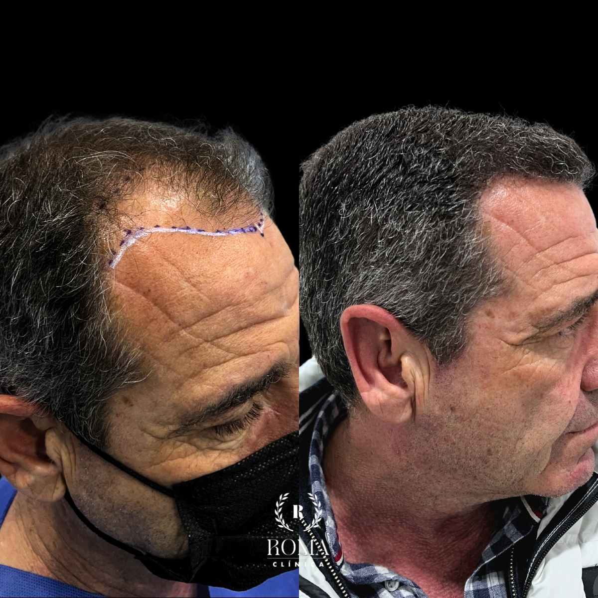 La mejor clínica estética para tu transplante capilar Imagen (3) antes y después transplante capilar