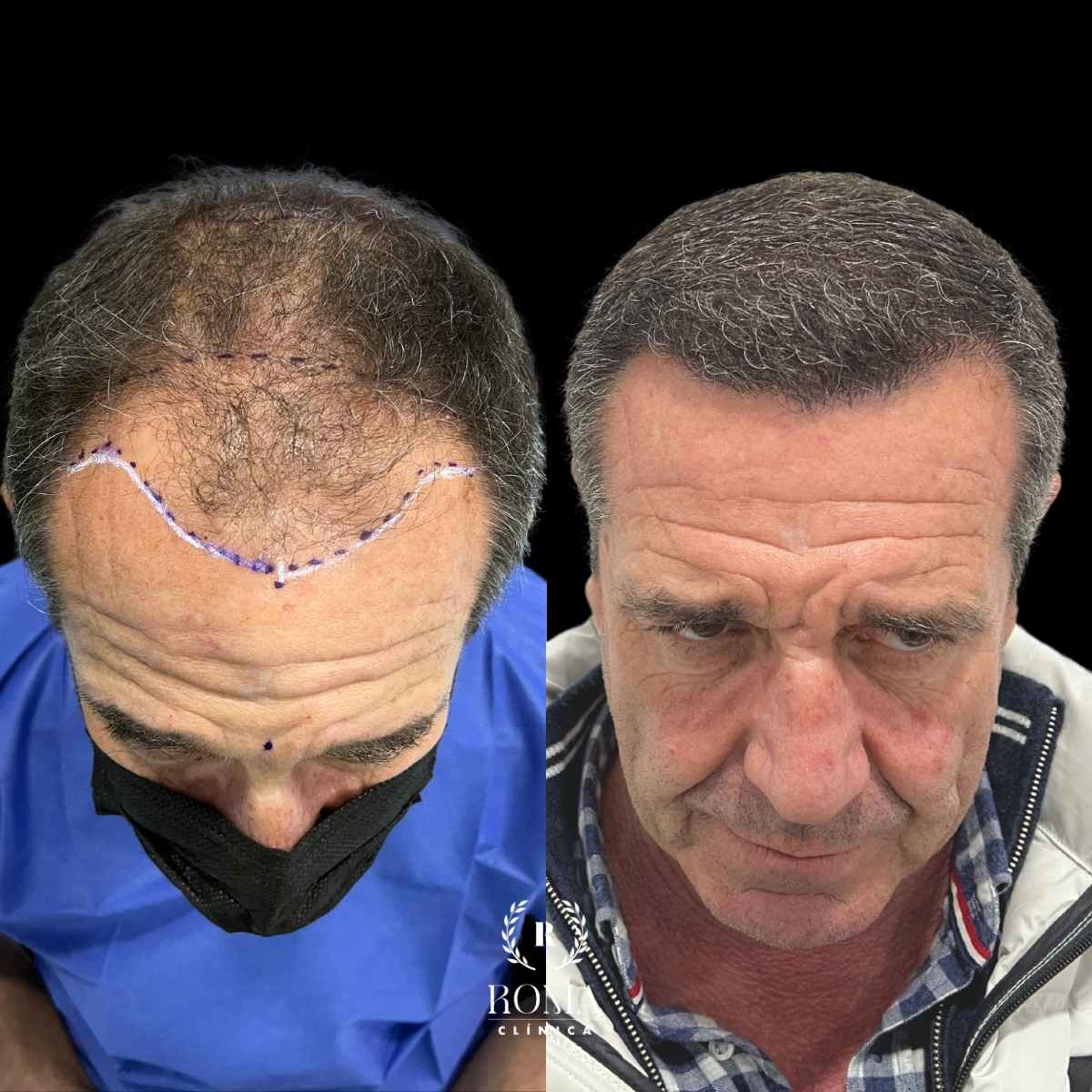 La mejor clínica estética para tu transplante capilar Imagen (4) antes y después transplante capilar