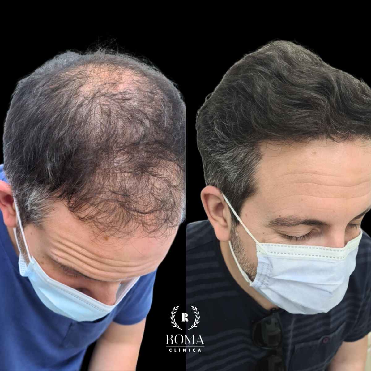 La mejor clínica estética para tu transplante capilar Imagen (1) antes y después transplante capilar