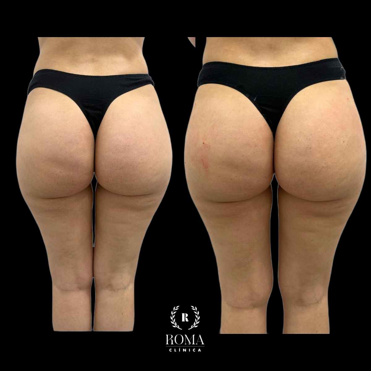 El mejor centro de medicina estetica en aumento de gluteos de malaga Imagen resultados efectivos paciente aumento gluteos