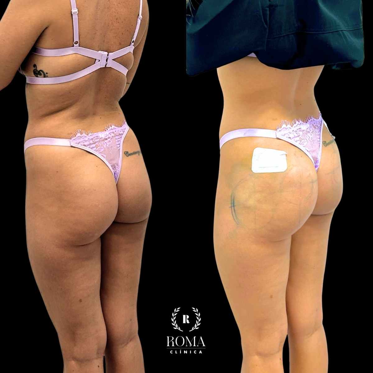 La mejor clinica de medicina estética en malaga Imagen resultados aumento de gluteos