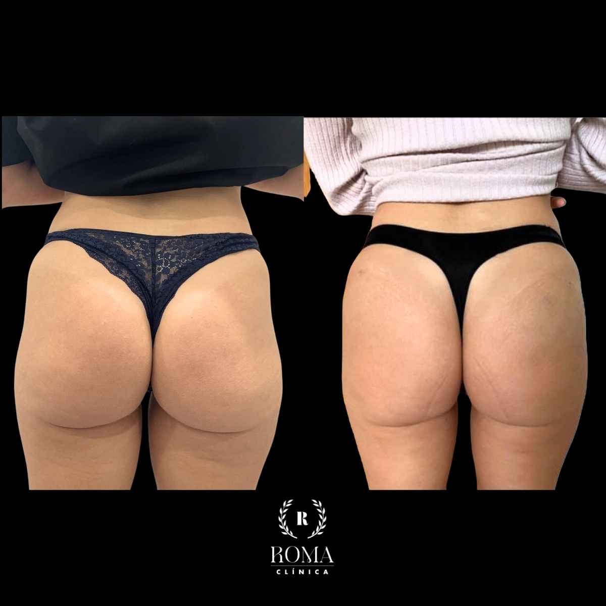 El mejor centro de medicina estetica en malaga Imagen antes y después paciente aumento de gluteos