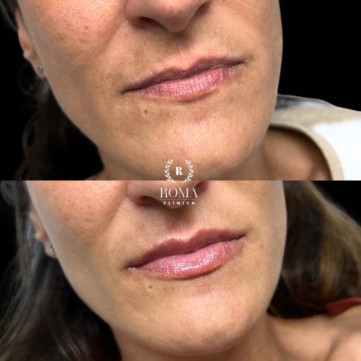 Obtén unos labios voluminosos con medicina estetica facial, Clinica Roma malaga Imagen proceso de aumento labios malaga en la mejor clinica estetica malaga, Clinica Roma