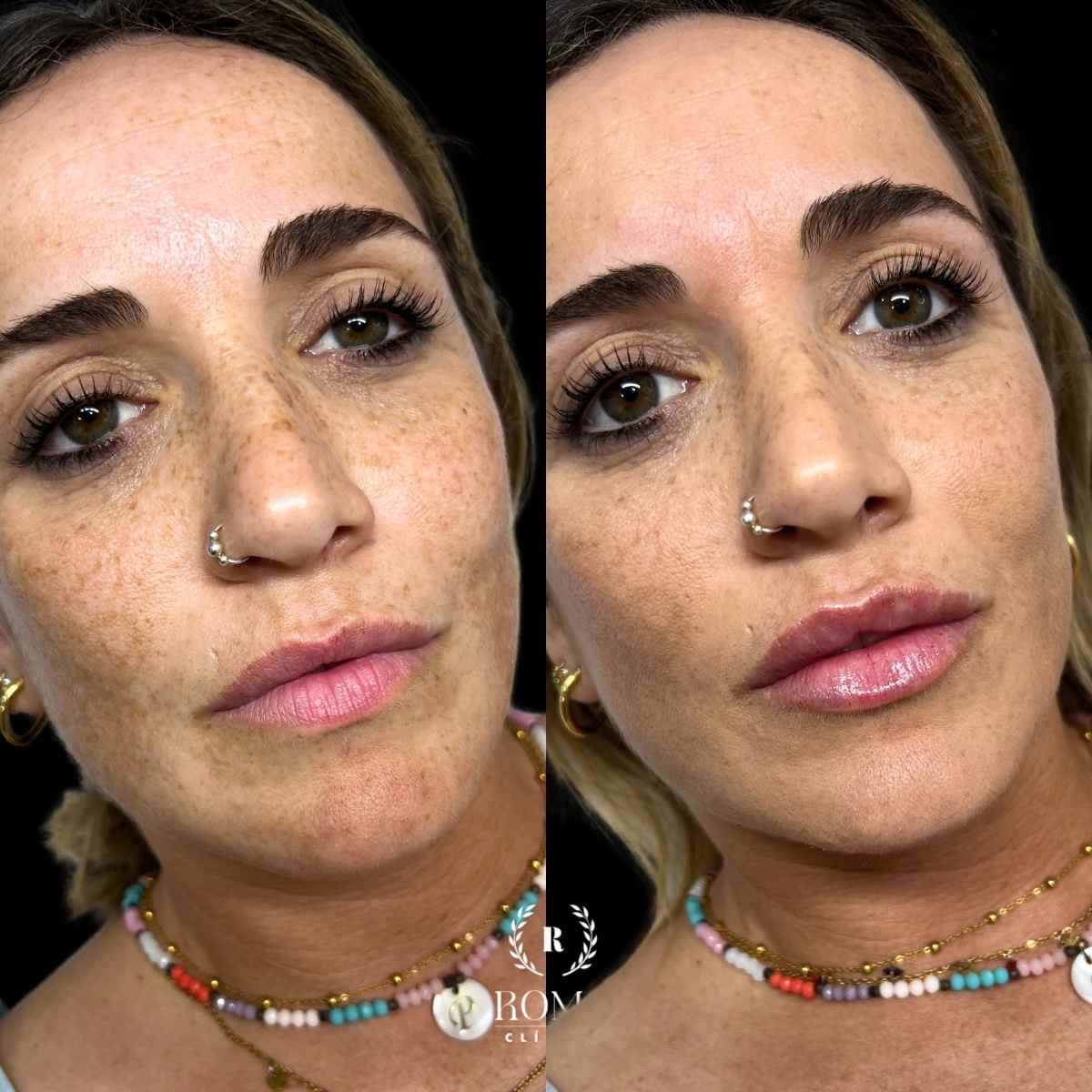 Obtén unos labios voluminosos con aumento de labios en clinica Roma malaga Imagen resultado de aumento de labios, la mejor clinica estetica malaga, clinica Roma