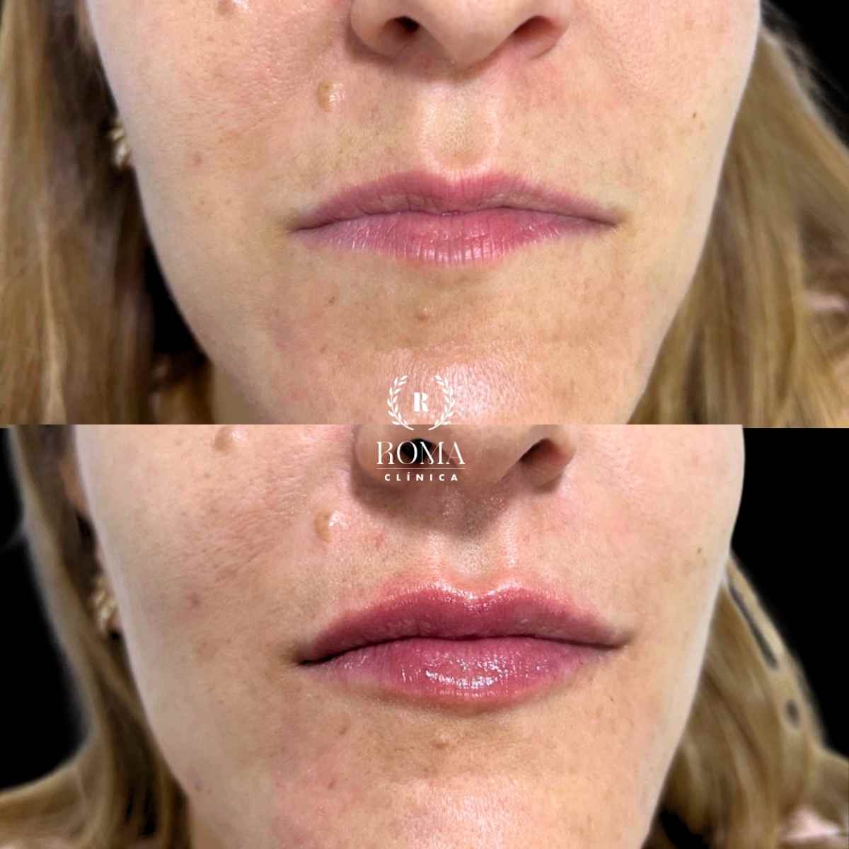 Labios voluminosos en malaga, la mejor clinica estetica malaga, Clinica Roma Imagen tratamiento de aumento de labios en la mejor clinica estetica de malaga, Clinica Roma