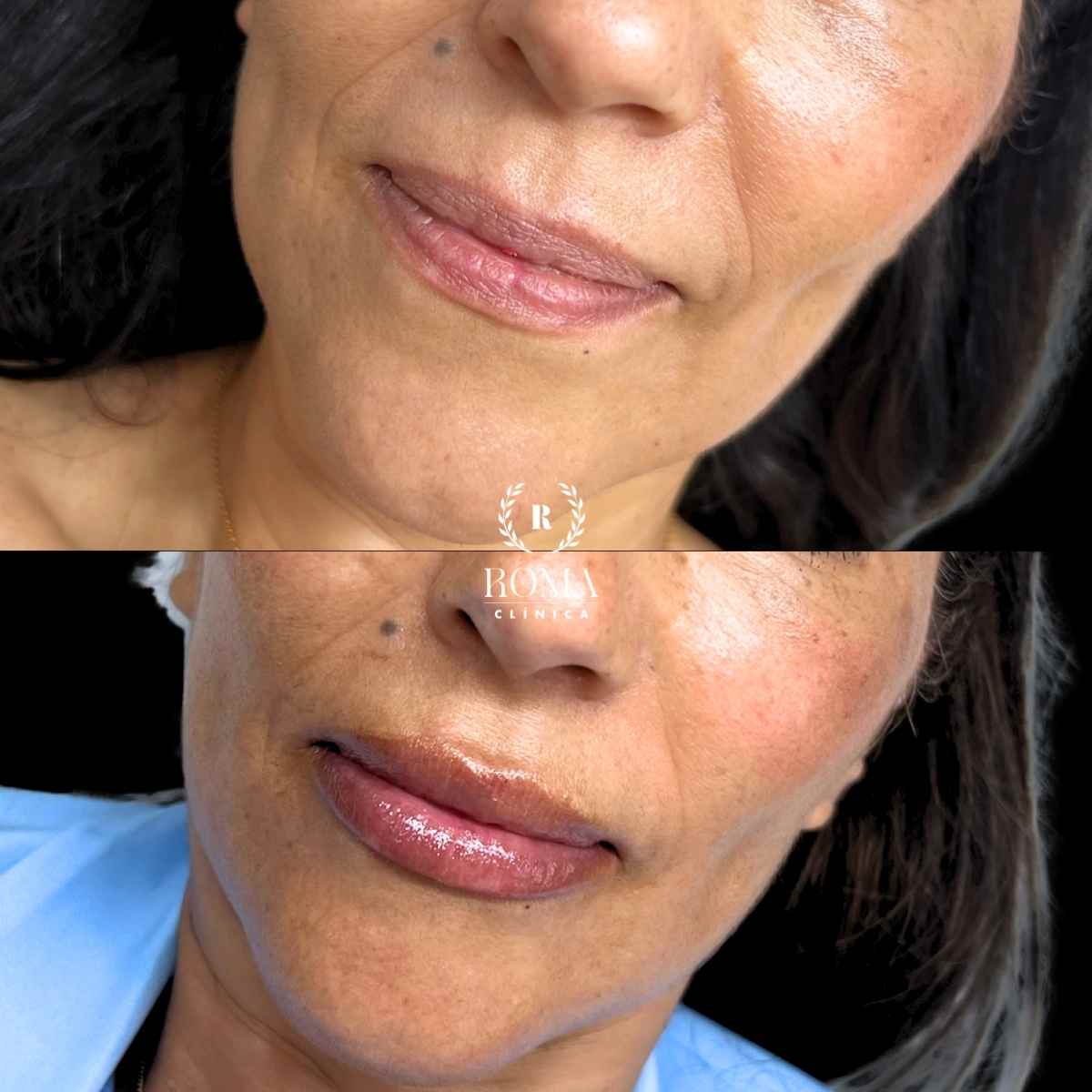 Tratamiento de labios mlaga, medicina estetica facial, Clinica Roma Imagen labios perfilados y voluminosos con tratamiento facial en la mejor clinica estetica malaga, clinica Roma