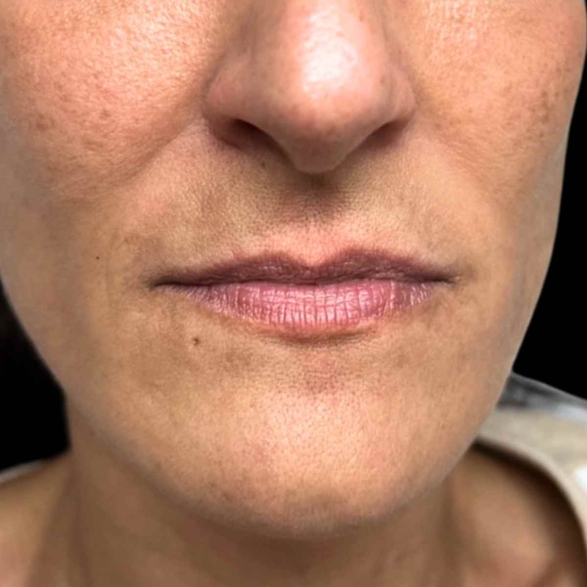 Imagen proceso de aumento de labios en la mejor clinica estetica malaga, Clinica Roma