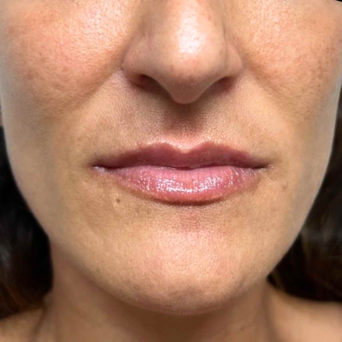 labios voluminosos con tratamiento estetico facial en la mejor clinica estetica malaga, Clinica Roma