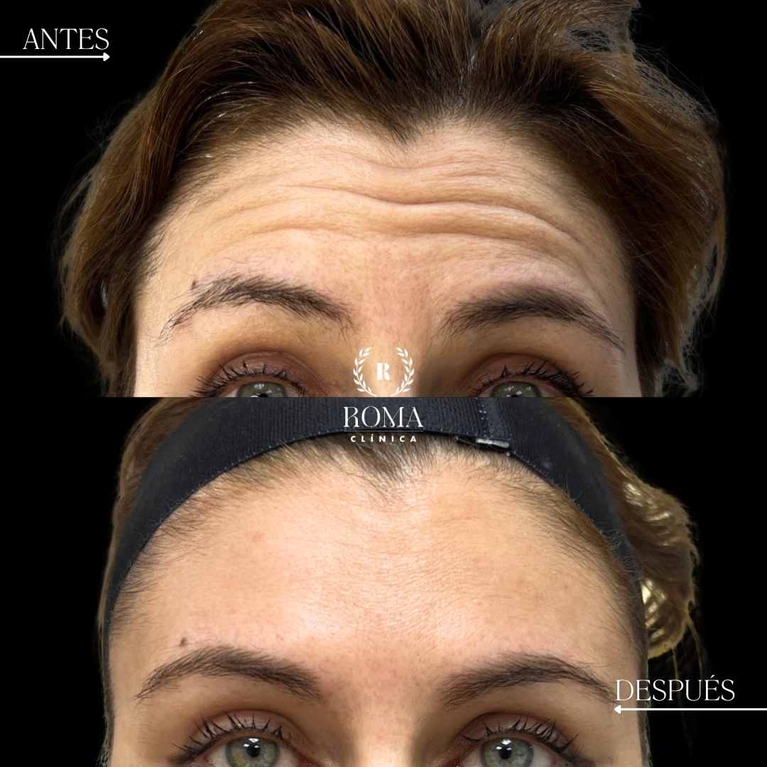 tratamiento para las arrugas en la mejor clinica estetica malaga , Clinica Roma