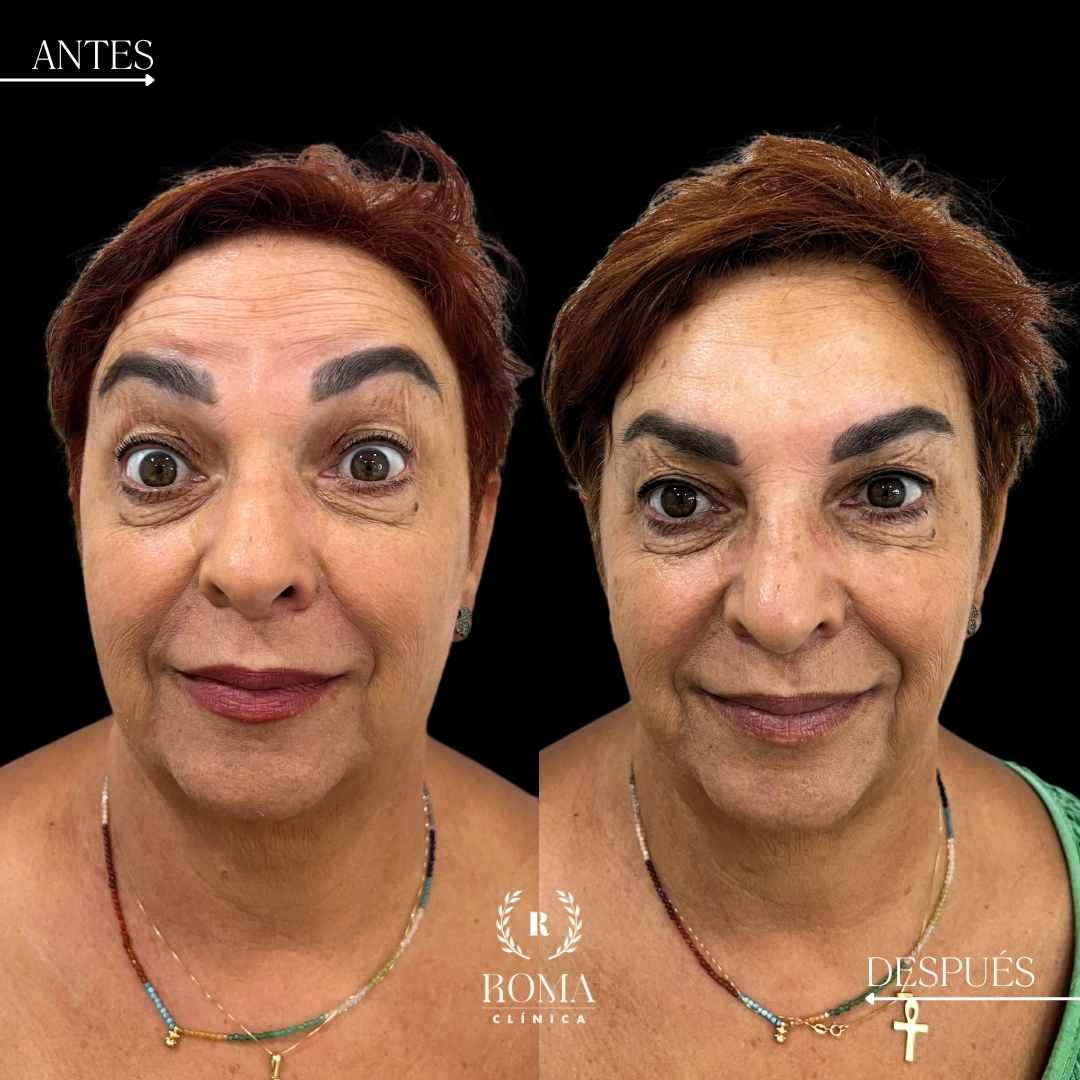 tratamiento de rejuvenecimiento facial no invasivo en Malaga realizado por la mejor clinica estetica, Clinica Roma