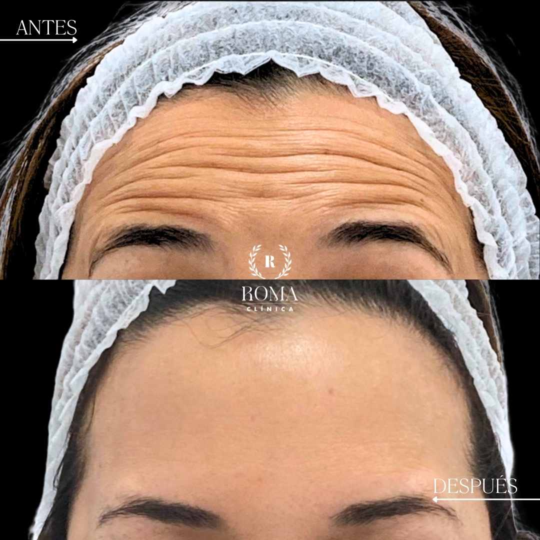 Tratamiento facial estetico en la mejor clinica estetica de malaga, clinica Roma