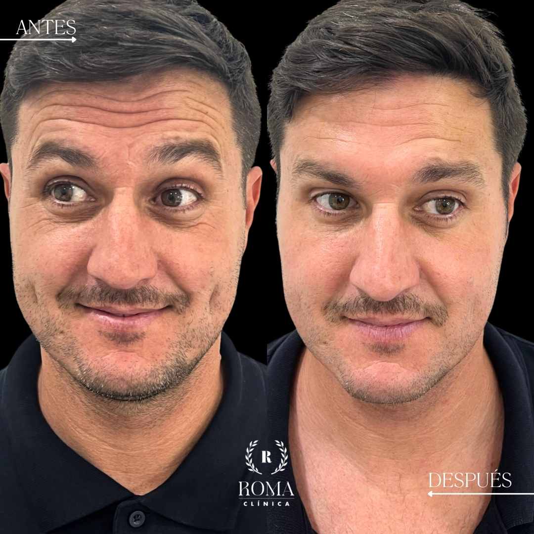 Rratamiento facial masculino en Malaga realizado por la mejor clinica estetica malaga, Clinica Roma, mostrando una reducción visible de las arrugas en la frente