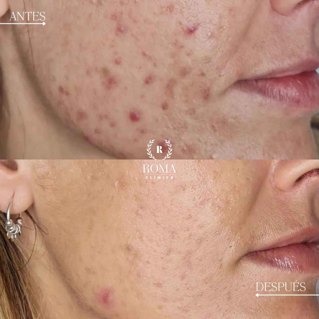 Imagen procedimiento paciente tratamiento acné