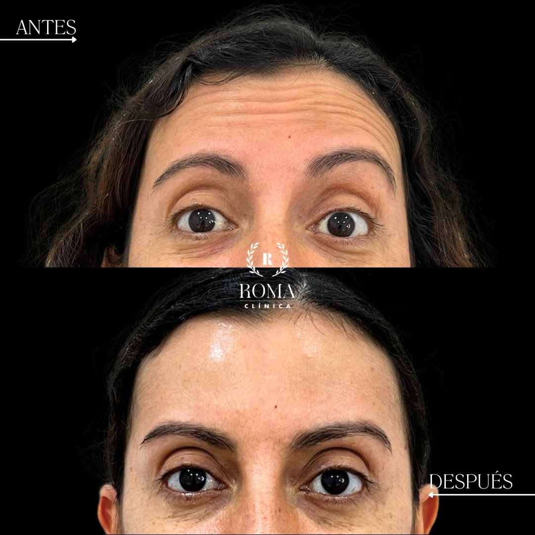 Antes y el después de un tratamiento facial en Malaga realizado por Clínica Roma, mostrando una disminucion de las arrugas de la frente en la mejor clinica estetica malaga