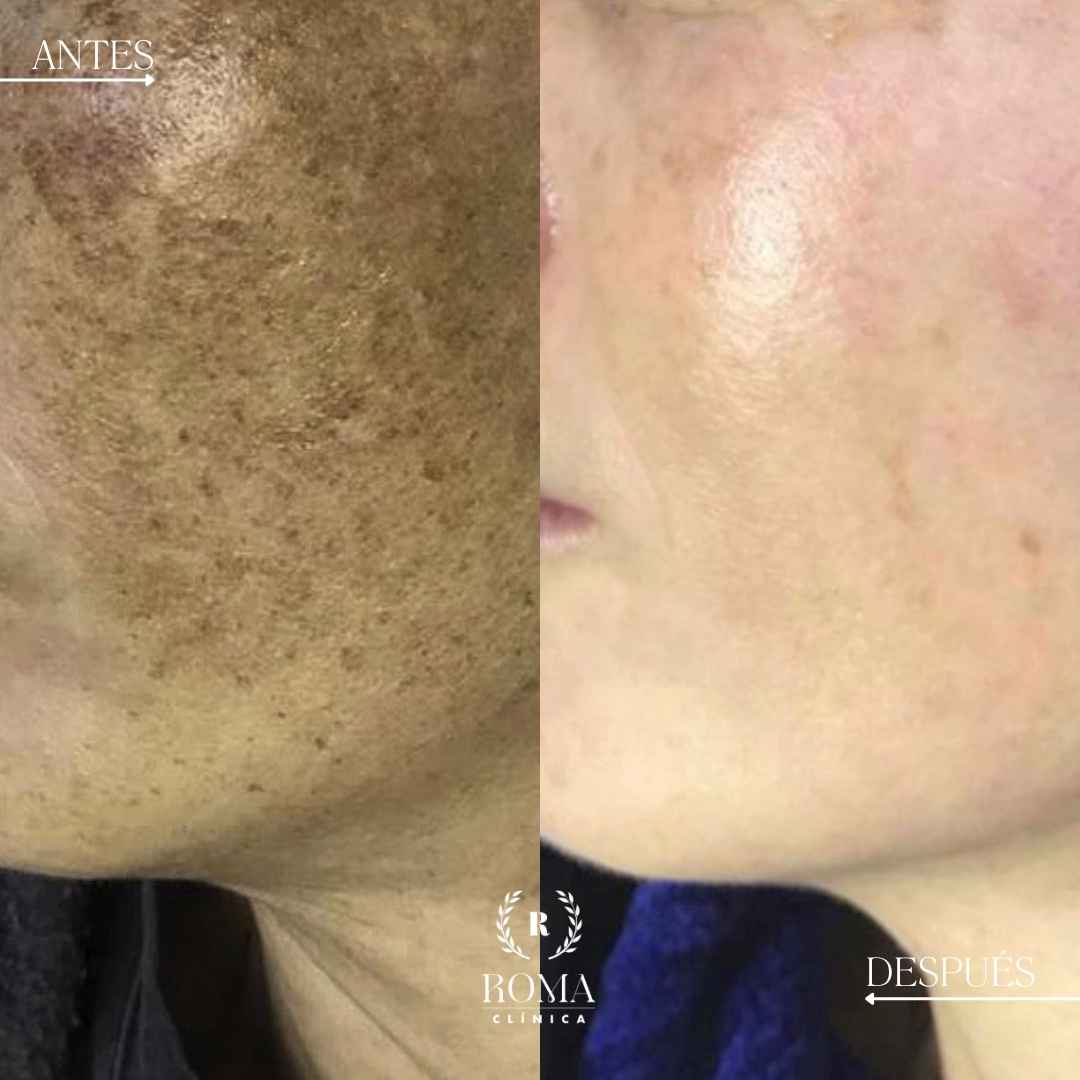 Imagen procedimiento melasma en paciente