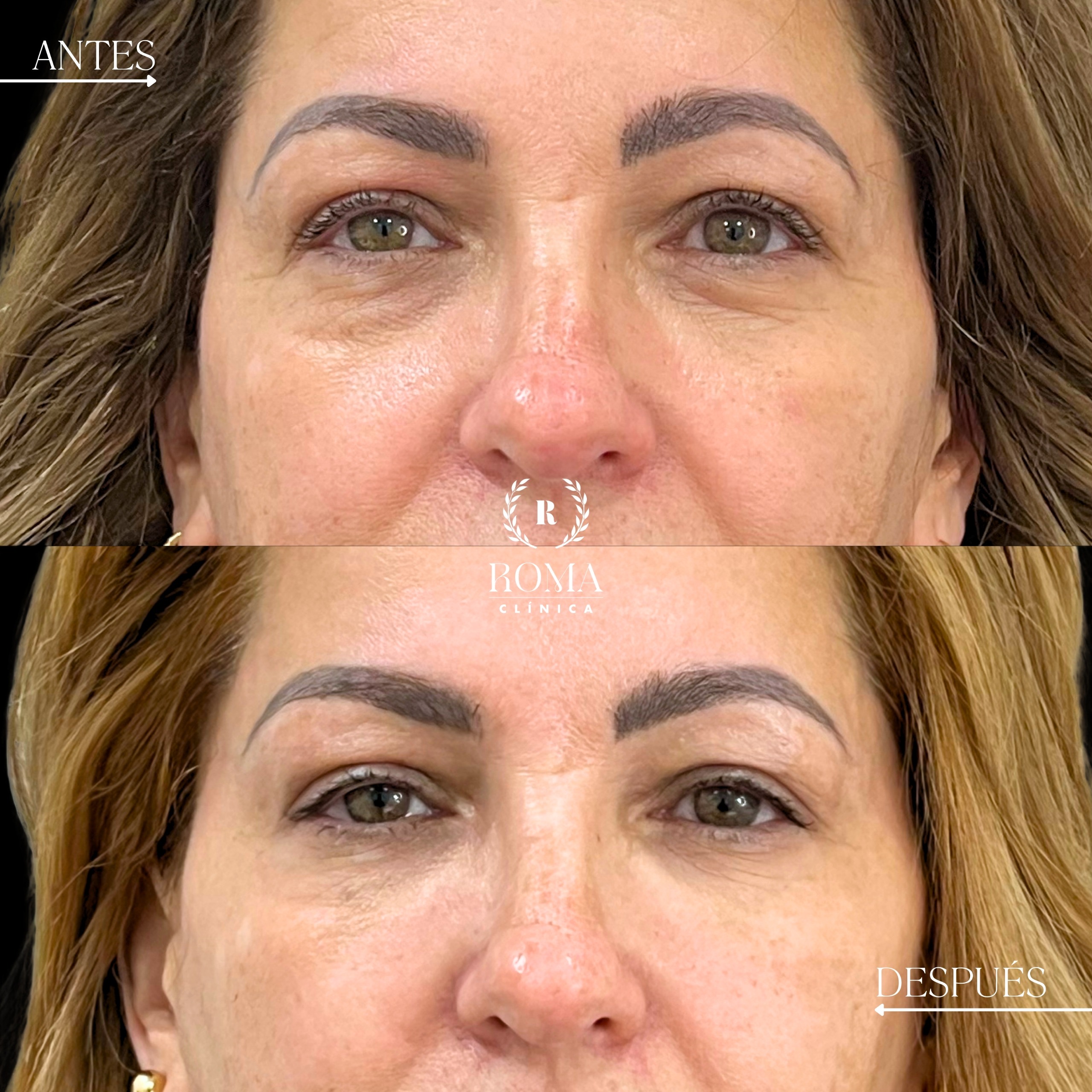 Imagen procedimiento antes y despues relleno de ojeras con acido hialuronico
