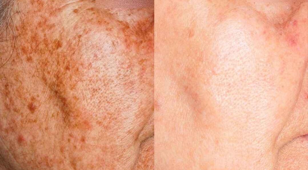 Imagen procedimiento eliminación de manchas en paciente