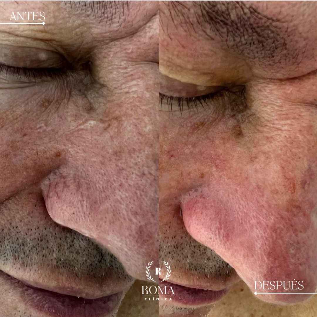 Imagen procedimiento arañas vasculares en paciente