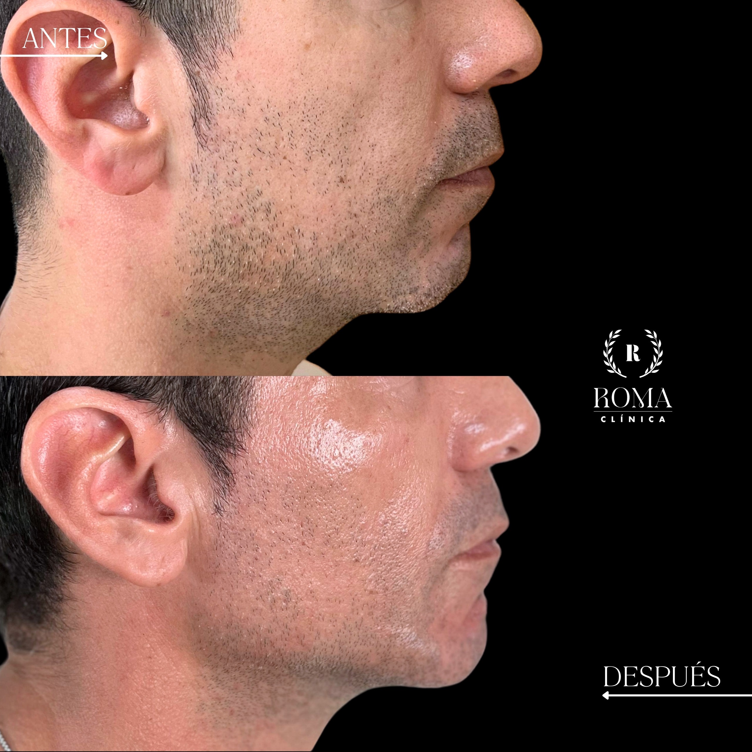 Imagen paciente antes y después en marcacion mandibular