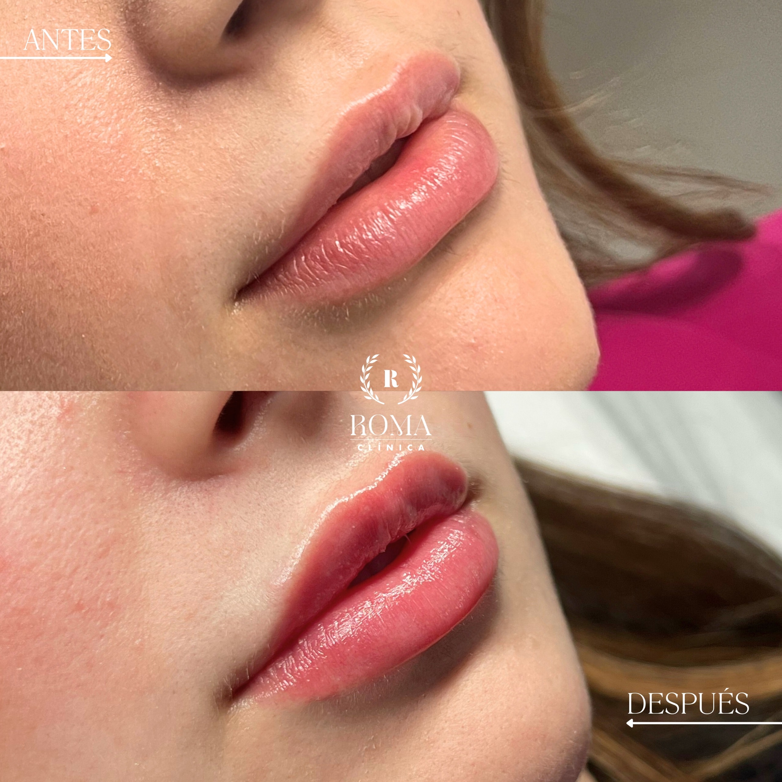 Imagen paciente labios antes y despues acido hialuronico