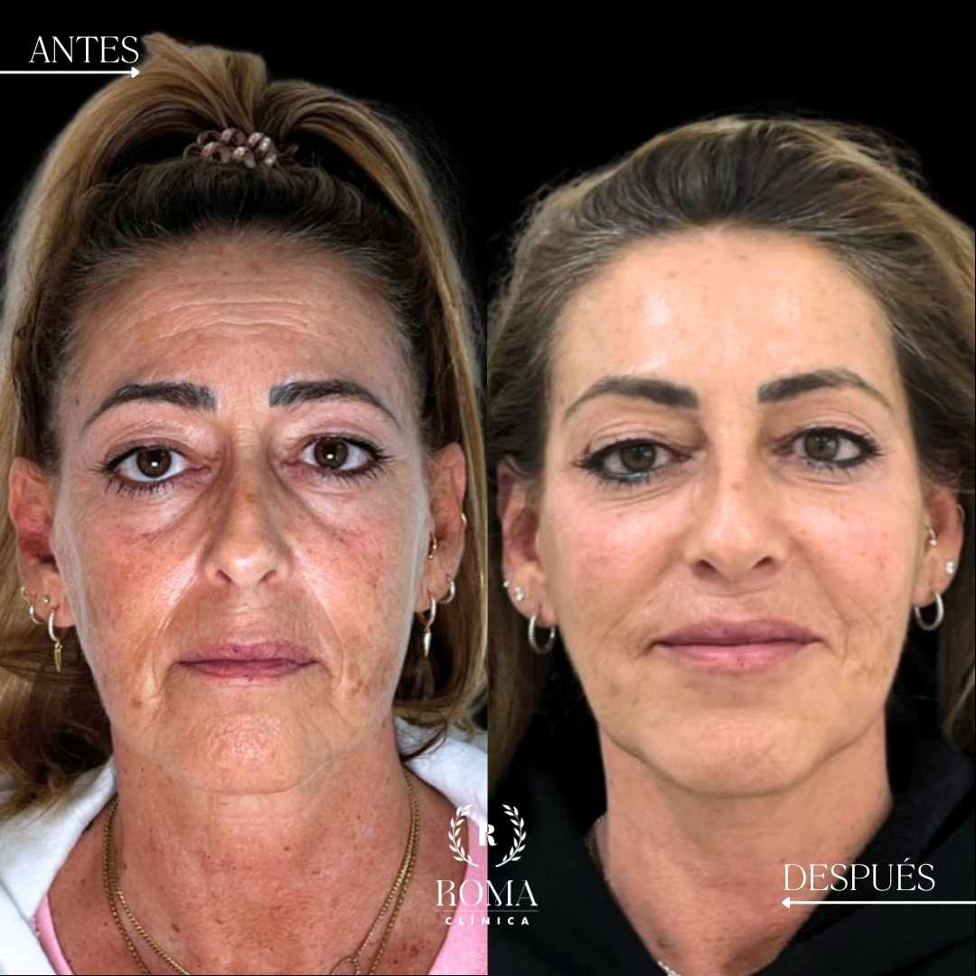 Imagen paciente antes y despues en rejuvenecimiento facial
