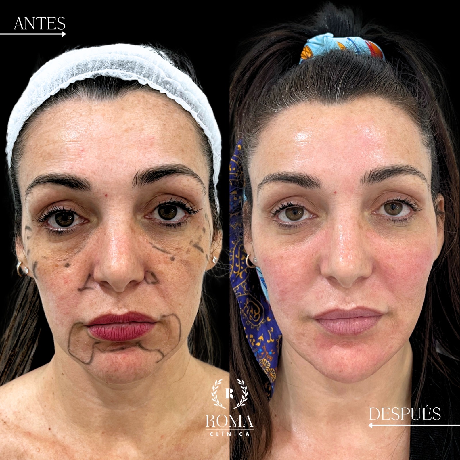Imagen paciente procedimiento estetico fullface