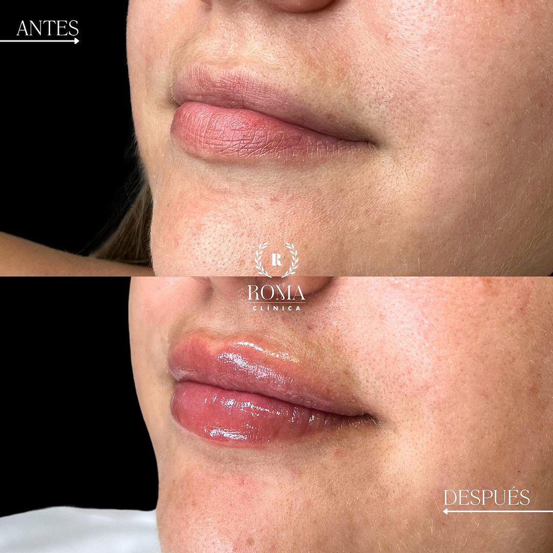 Imagen procedimiento aumento de labios paciente antes y después