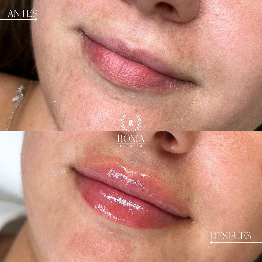 Imagen procedimiento antes y después aumento de labios