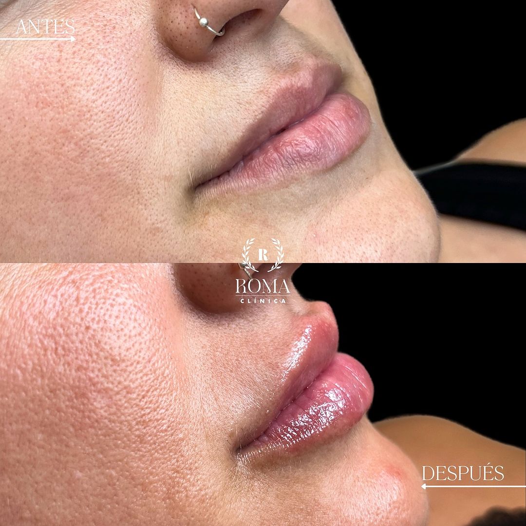 Imagen procedimiento aumento de labios paciente