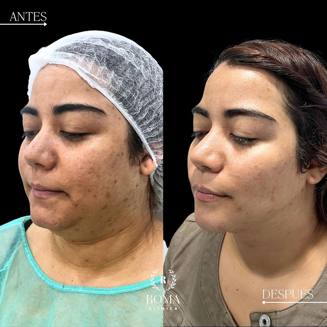 Imagen procedimiento bichectomia resultados paciente