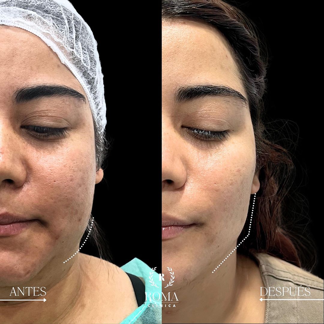 Imagen procedimiento bichectomia antes y después paciente