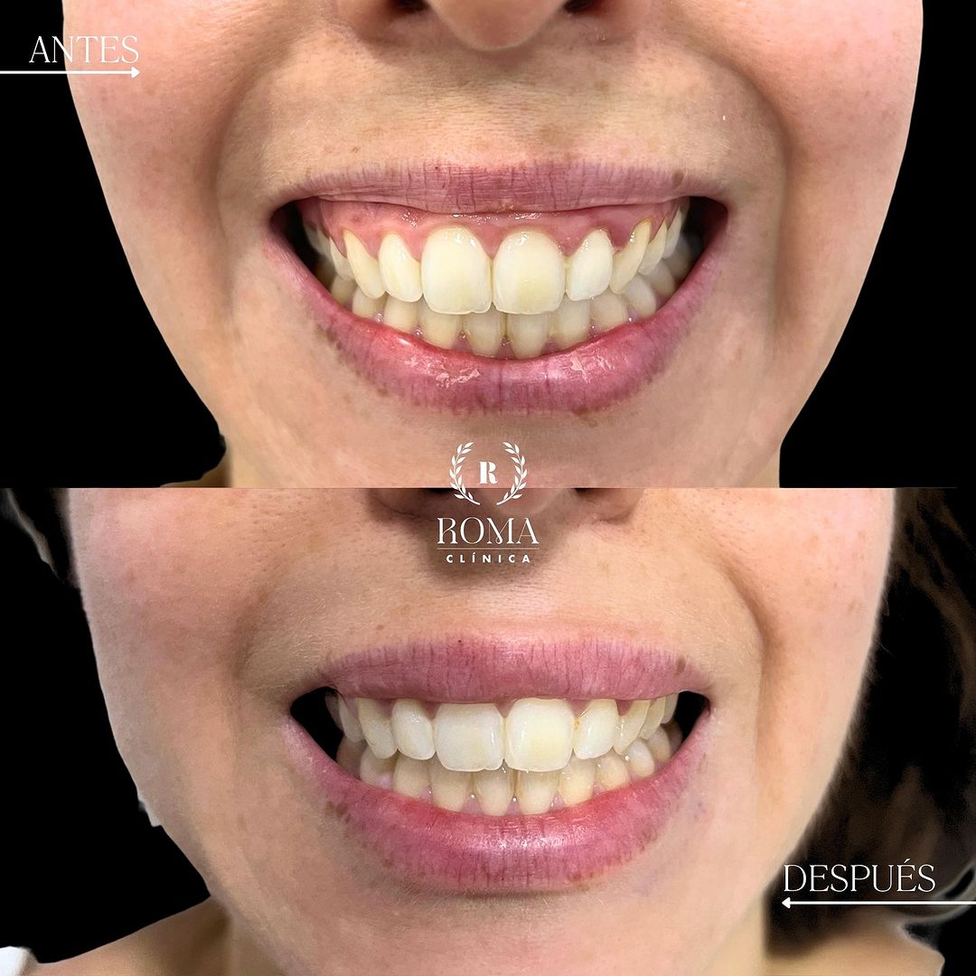 Imagen procedimiento sonrisa gingival paciente