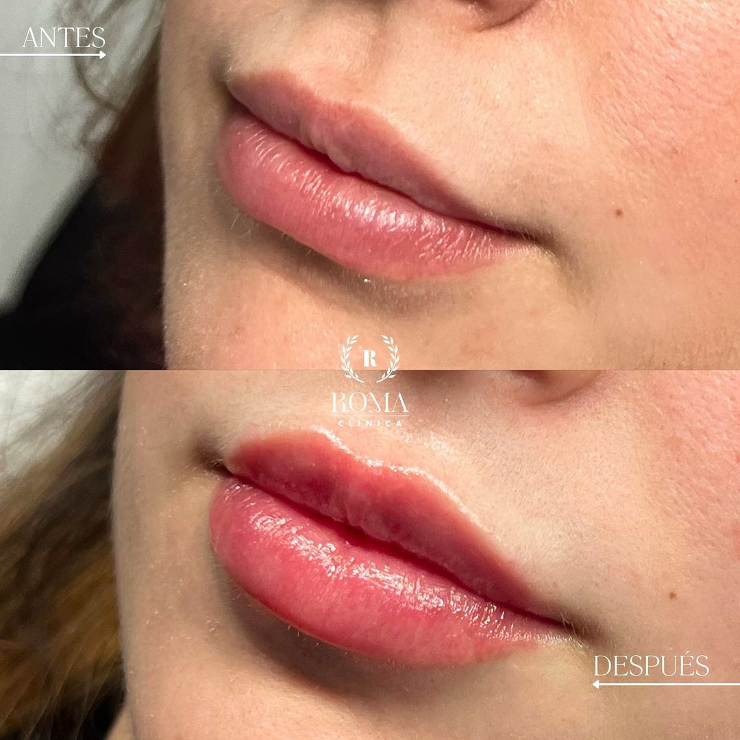 Imagen procedimiento en paciente aumento de labios antes y después