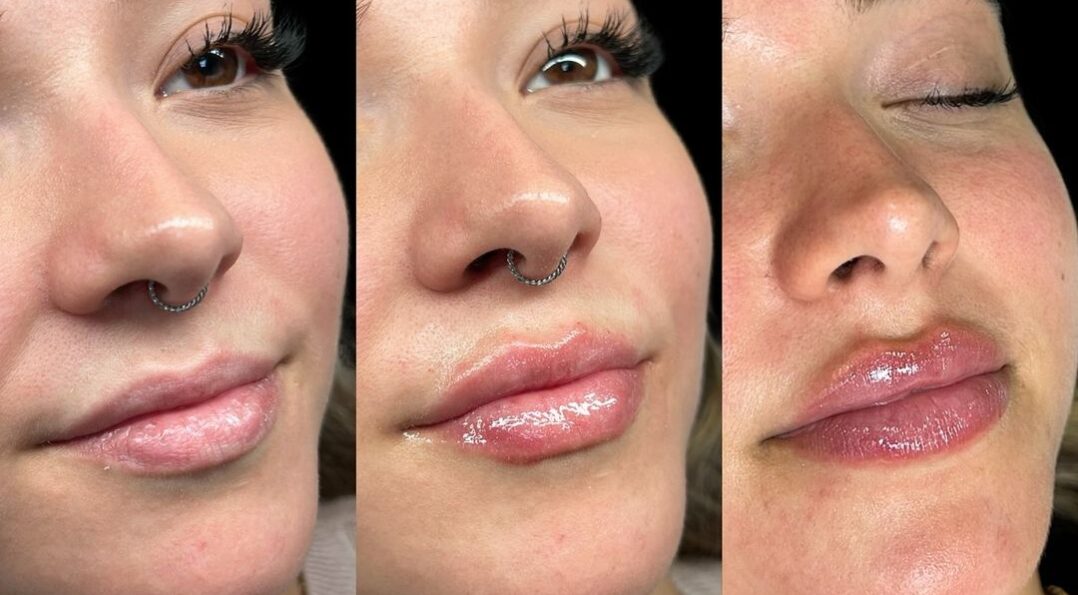 Imagen paciente aumento de labios antes y después