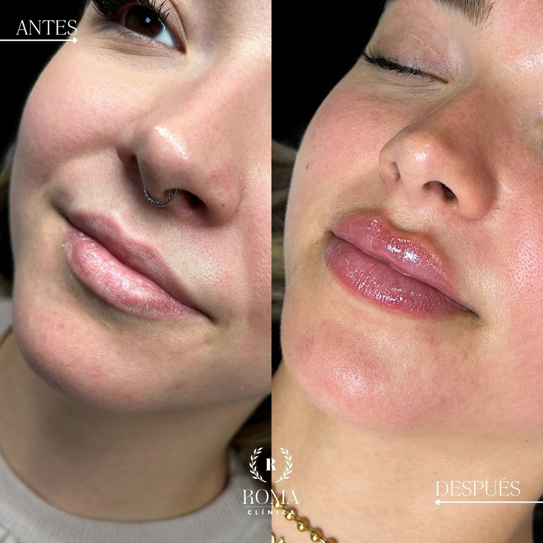 Imagen procedimiento aumento de labios antes y después paciente