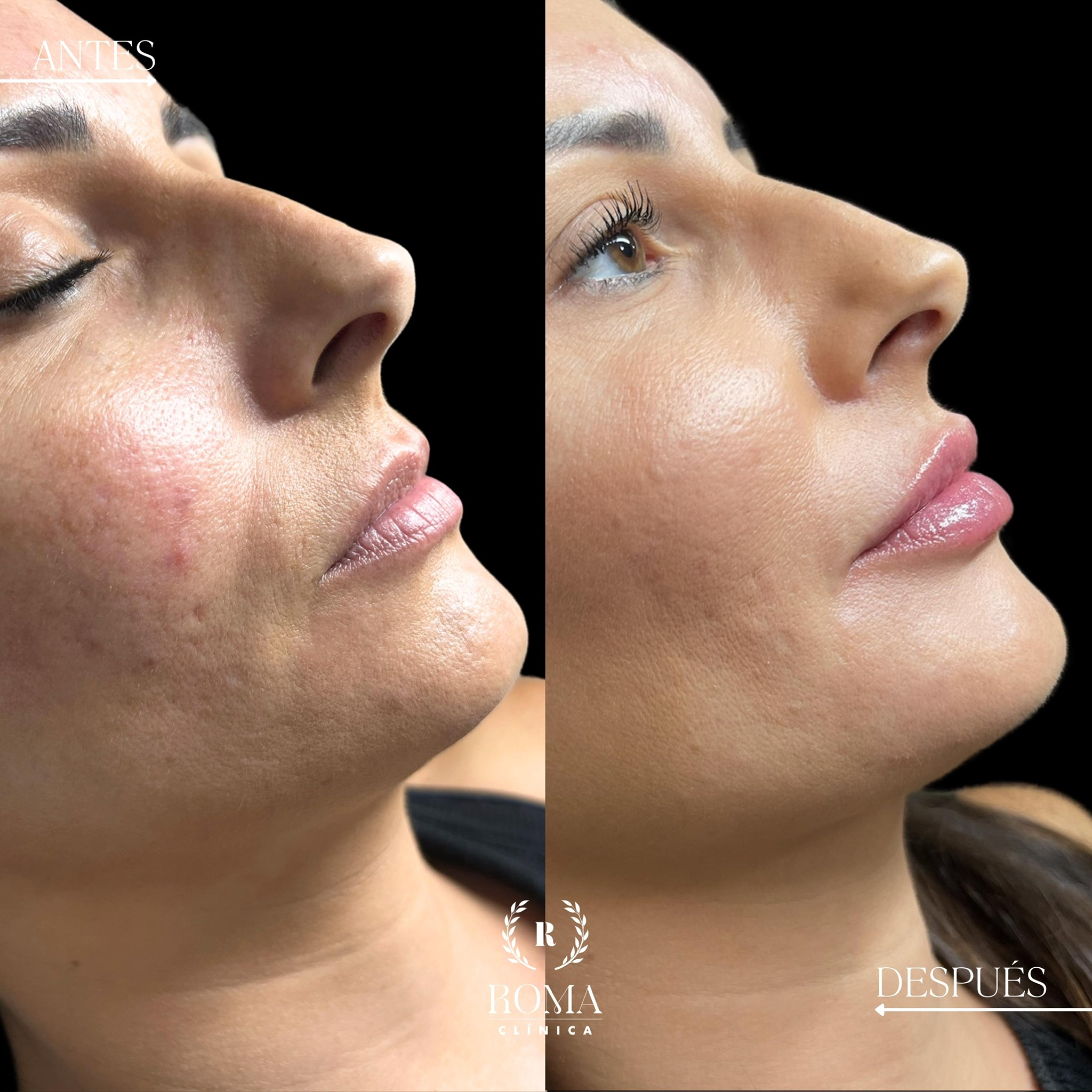 Imagen procedimiento aumento de labios paciente