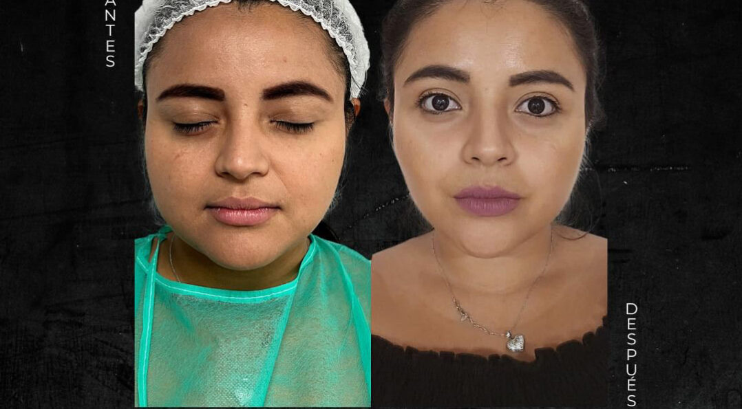 Imagen procedimiento bichectomia antes y después